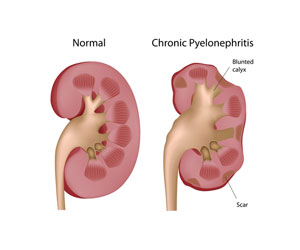 bolezn-pochek-xronicheskij-pielonefrit