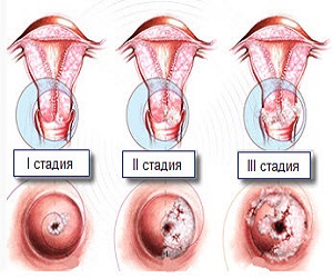 displaziya_shejki_matki_simptomy_i_opisanie