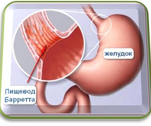 zabolevanie_pishhevod_barretta_i_ego_lechenie